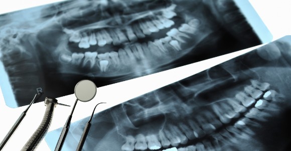 Tooth Extractions in Toronto